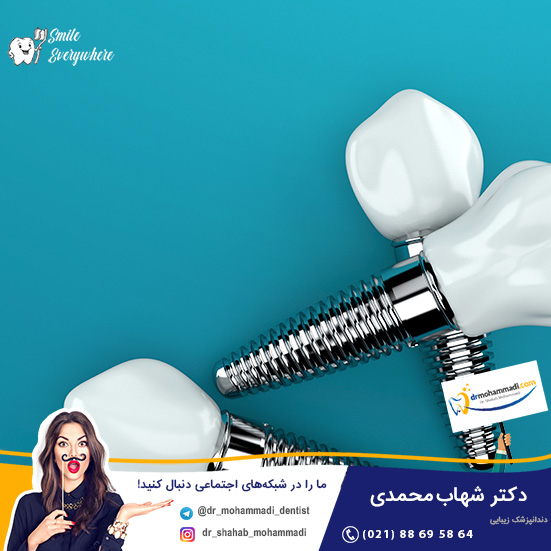 نحوه نگاهداری و بهداشت ایمپلنت دندان چگونه است؟ - کلینیک دندانپزشکی دکتر شهاب محمدی